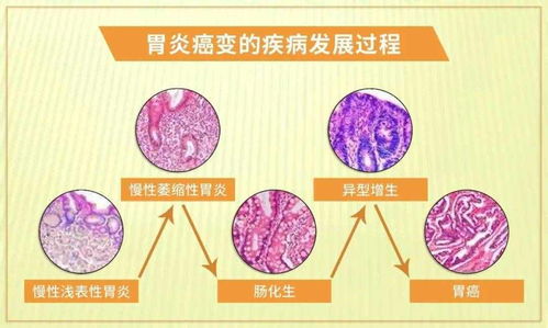 关于胃病的生活常识(关于胃病的症状)