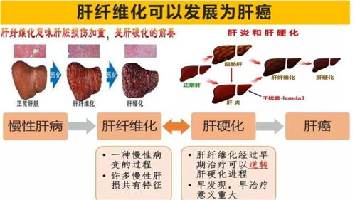 肝硬化生活常识(肝硬化日常生活方式和饮食人)